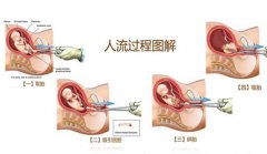 女性想要做试管需要经历的步骤