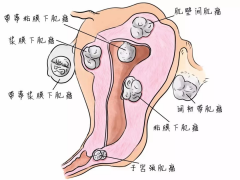 Hello IVF：子宫肌瘤要做试管需要先做手术吗？